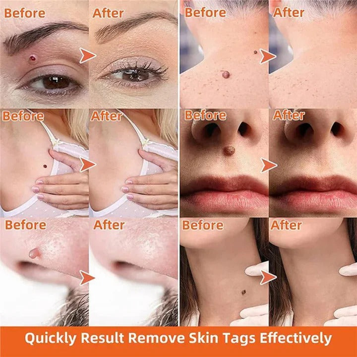 Loop-Based Application Tool for Manual Skin Tag Removal