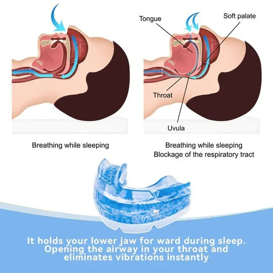 Adjustable Anti-Snore Mouthpiece for Nighttime Jaw Positioning and Airflow Support