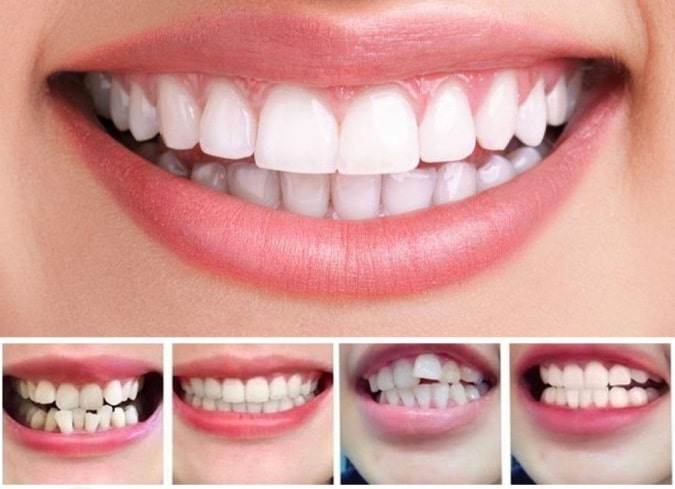 Teeth Alignment Tray with Three Progressive Levels and Universal Mold Design