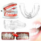 Teeth Alignment Tray with Three Progressive Levels and Universal Mold Design