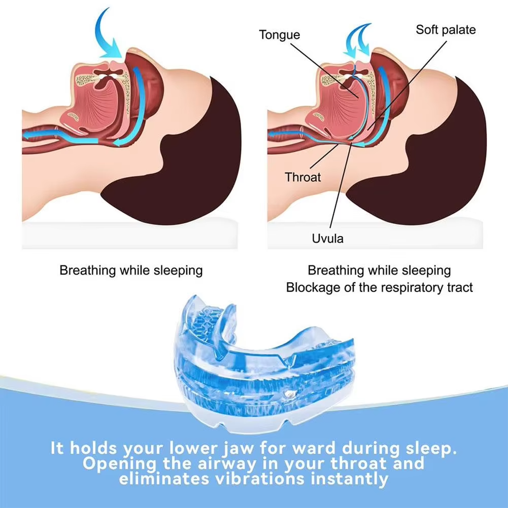 Sjbackyard Adjustable Mandibular Advancement Device for Snoring Reduction