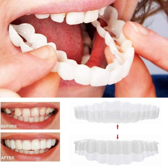 Removable Upper and Lower Cosmetic Smile Cover System