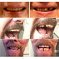 Temporary False Teeth Cover for Cosmetic Smile Appearance