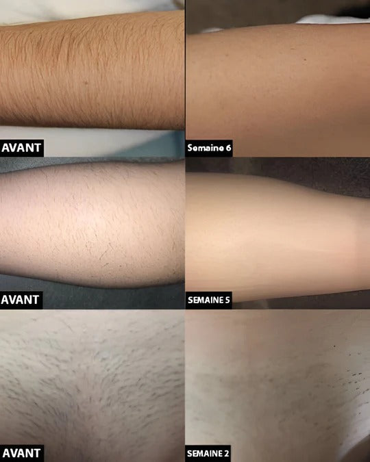 At-Home Laser Hair Removal Device for Full Body Use