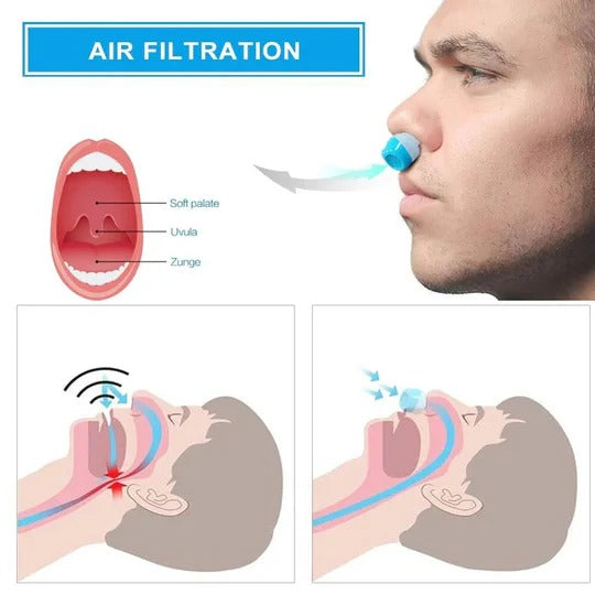 Airing Micro-CPAP Device for Hassle-Free Snoring Reduction