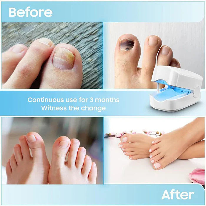 Portable Nail Fungus Laser Device with Rechargeable Battery and One-Button Operation