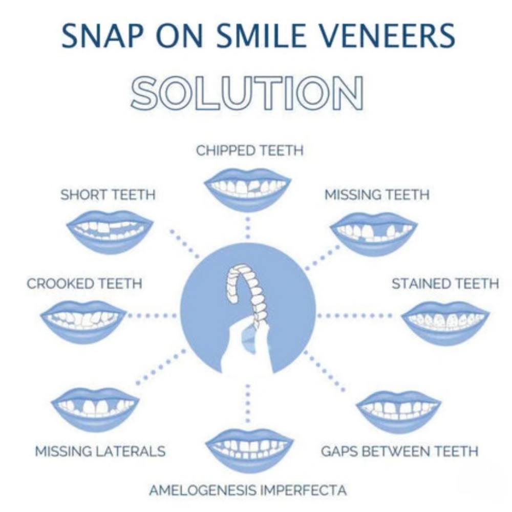 Clip On Smile Veneer for Upper and Lower Teeth