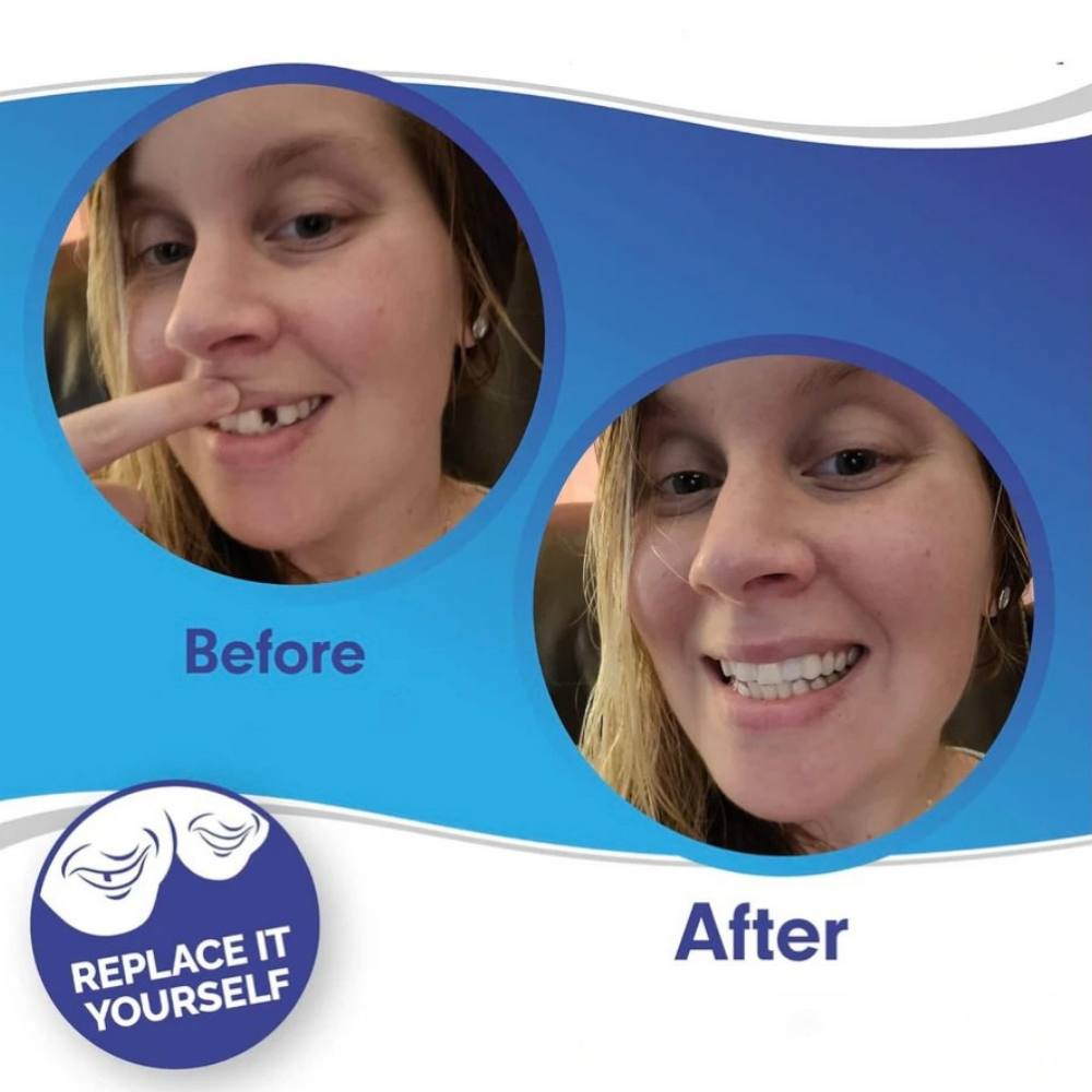 Clip On Smile Veneer for Upper and Lower Teeth