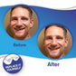 Clip On Smile Veneer for Upper and Lower Teeth